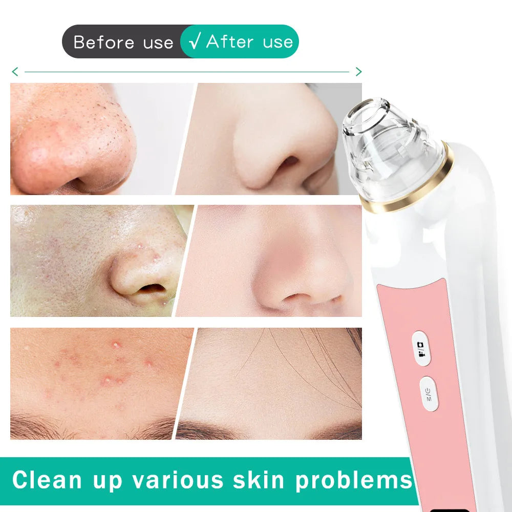 Mychway HD Camera Blackhead Remover With Light For Facial Cleaning