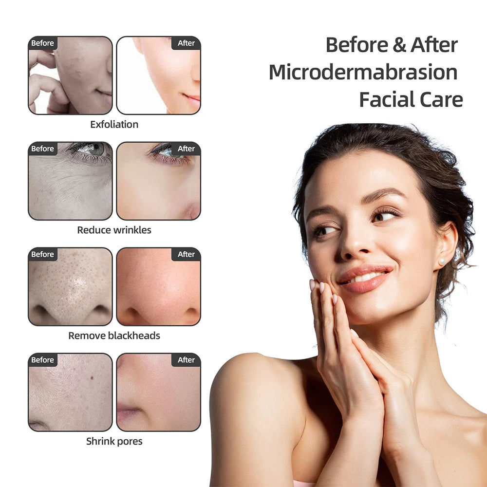 Foreverlily Diamond Microdermabrasion Machine for Skin Care