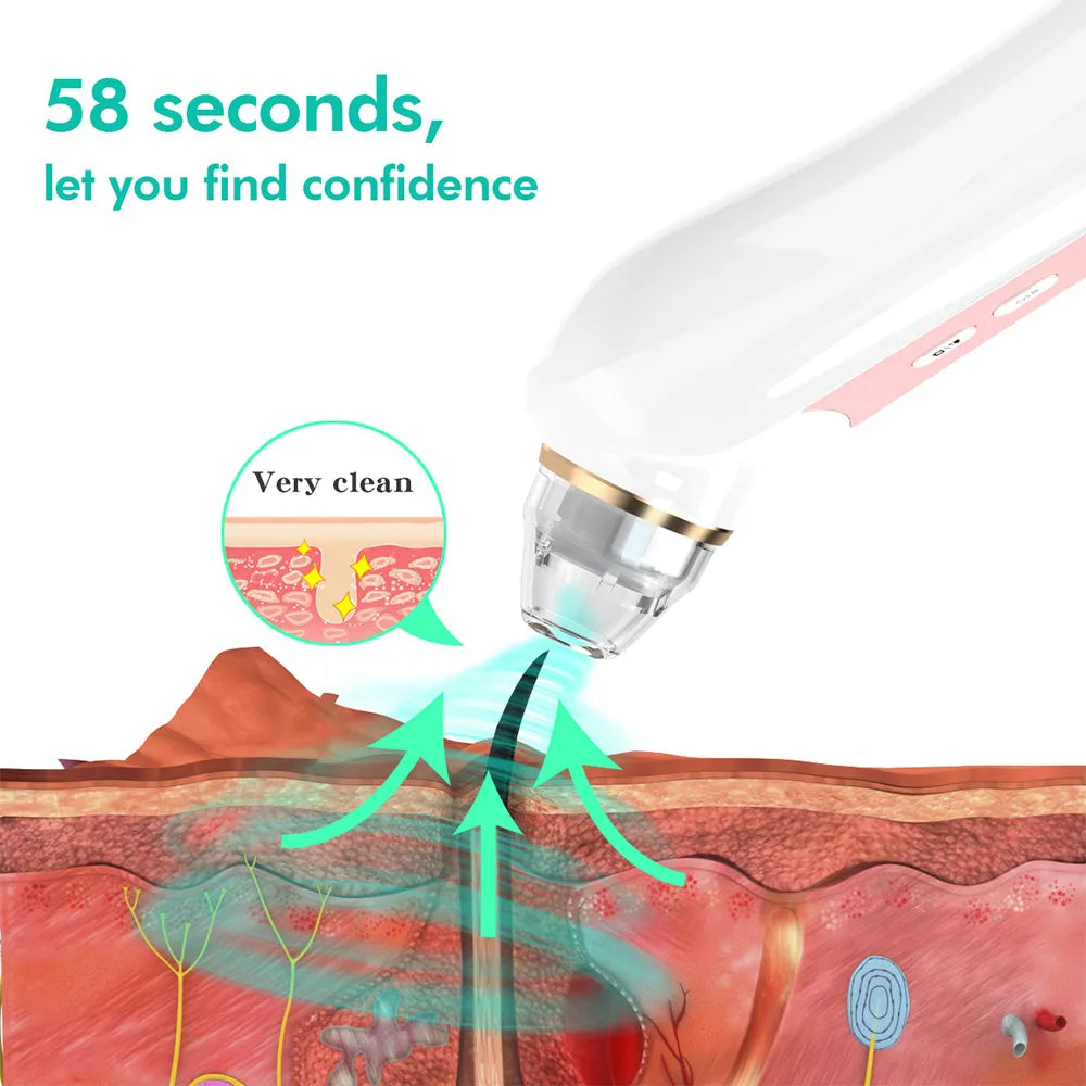Mychway HD Camera Blackhead Remover With Light For Facial Cleaning